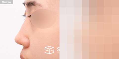 슈가성형외과 첫) 콧대 + 코끝 + 매부리코 + 절골 + 비주 내리기 + 귀연골 전후사진 - 45도 수술 전후 비교