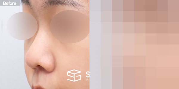 슈가성형외과 첫) 콧대 + 코끝 + 복코 전후사진 - 정면 수술 전후 비교