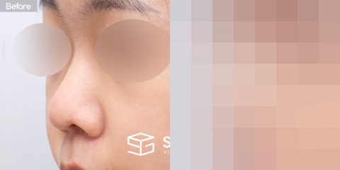 슈가성형외과 첫) 콧대 + 코끝 + 복코 전후사진 - 정면 수술 전후 비교