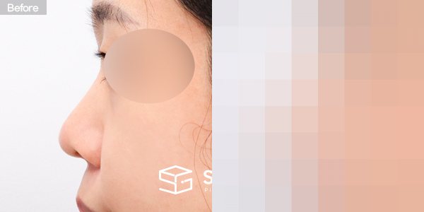 슈가성형외과 첫) 콧대 + 코끝 + 복코 전후사진 - 45도 수술 전후 비교
