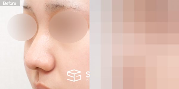 슈가성형외과 첫) 콧대 + 코끝 + 복코 + 휜코 + 콧볼축소 + 비중격 연장 전후사진 - 정면 수술 전후 비교