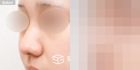 슈가성형외과 첫) 콧대 + 코끝 + 복코 + 휜코 + 콧볼축소 + 비중격 연장 전후사진 - 정면 수술 전후 비교