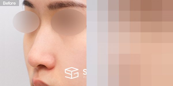 슈가성형외과 첫) 콧대 + 코끝 + 매부리코 + 복코 + 절골 + 비중격 + 귀연골 전후사진 - 정면 수술 전후 비교