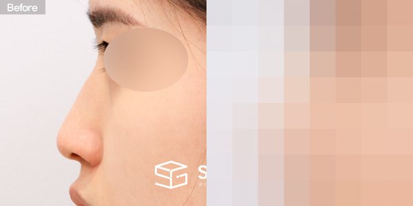 슈가성형외과 첫) 콧대 + 코끝 + 매부리코 + 복코 + 절골 + 비중격 + 귀연골 전후사진 - 45도 수술 전후 비교