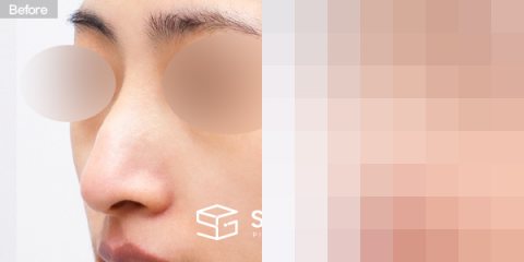 슈가성형외과 첫) 콧대 + 코끝 + 매부리코 + 무보형물 코성형 + 휜코 + 절골 + 비주교정 + 비중격 전후사진 - 정면 수술 전후 비교