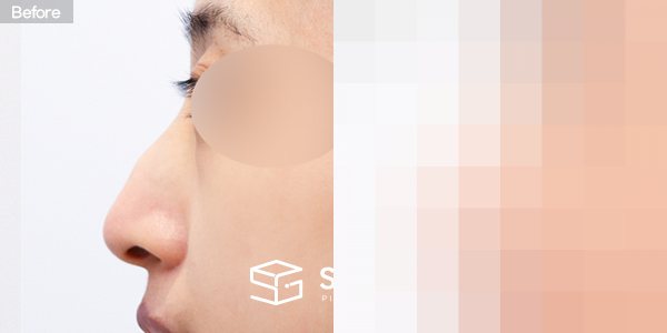 슈가성형외과 첫) 콧대 + 코끝 + 매부리코 + 무보형물 코성형 + 휜코 + 절골 + 비주교정 + 비중격 전후사진 - 45도 수술 전후 비교