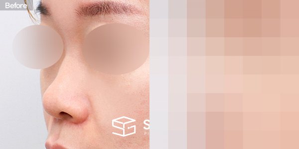 슈가성형외과 첫) 콧대 + 코끝 + 복코 + 절골 + 콧볼축소 + 자가늑 전후사진 - 정면 수술 전후 비교