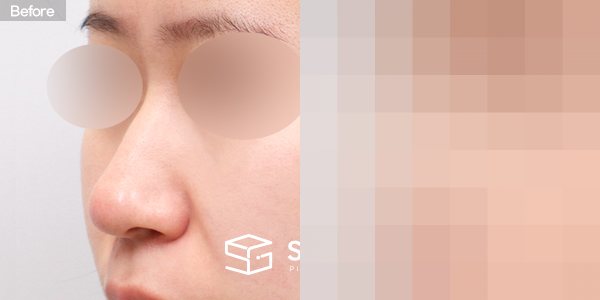 슈가성형외과 첫) 콧대 + 코끝 + 복코 + 콧볼축소 + 비주 지지 + 비중격 + 귀연골 전후사진 - 정면 수술 전후 비교