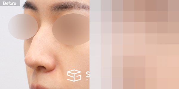 슈가성형외과 첫) 코끝 + 매부리코 + 무보형물 코성형 + 절골 + 귀 뒤 근막 전후사진 - 정면 수술 전후 비교