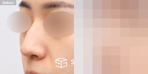 슈가성형외과 첫) 코끝 + 매부리코 + 무보형물 코성형 + 절골 + 귀 뒤 근막 전후사진 - 정면 수술 전후 비교
