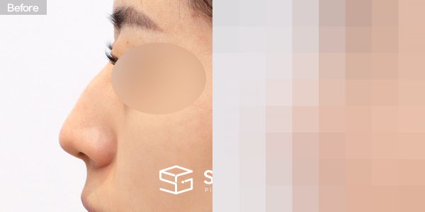 슈가성형외과 첫) 코끝 + 매부리코 + 무보형물 코성형 + 절골 + 귀 뒤 근막 전후사진 - 45도 수술 전후 비교
