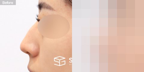 슈가성형외과 첫) 코끝 + 매부리코 + 무보형물 코성형 + 절골 + 귀 뒤 근막 전후사진 - 45도 수술 전후 비교