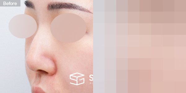 슈가성형외과 첫) 코끝 + 매부리코 + 무보형물 코성형 + 휜코 + 복코 + 절골 + 귀 뒤 근막 + 귀연골 전후사진 - 정면 수술 전후 비교