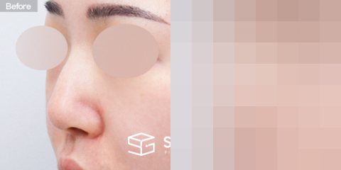 슈가성형외과 첫) 코끝 + 매부리코 + 무보형물 코성형 + 휜코 + 복코 + 절골 + 귀 뒤 근막 + 귀연골 전후사진 - 정면 수술 전후 비교