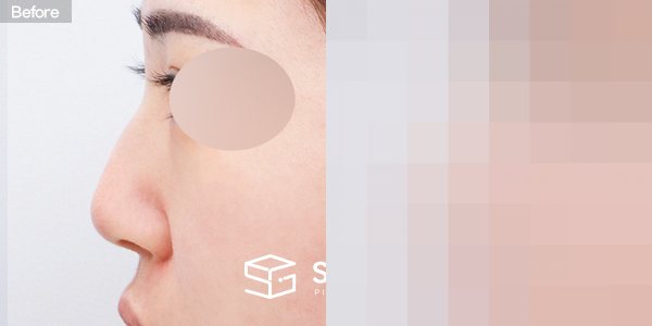 슈가성형외과 첫) 코끝 + 매부리코 + 무보형물 코성형 + 휜코 + 복코 + 절골 + 귀 뒤 근막 + 귀연골 전후사진 - 45도 수술 전후 비교