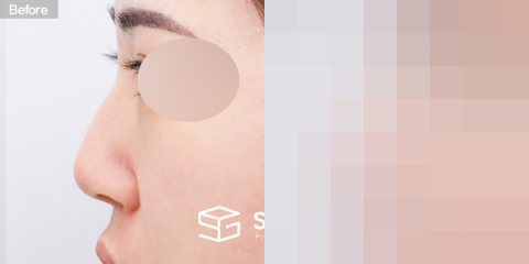 슈가성형외과 첫) 코끝 + 매부리코 + 무보형물 코성형 + 휜코 + 복코 + 절골 + 귀 뒤 근막 + 귀연골 전후사진 - 45도 수술 전후 비교