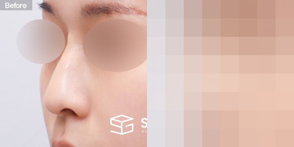 슈가성형외과 첫) 콧대 + 코끝 + 매부리코 + 귀연골 전후사진 - 정면 수술 전후 비교