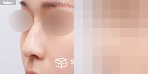 슈가성형외과 첫) 콧대 + 코끝 + 매부리코 + 귀연골 전후사진 - 정면 수술 전후 비교