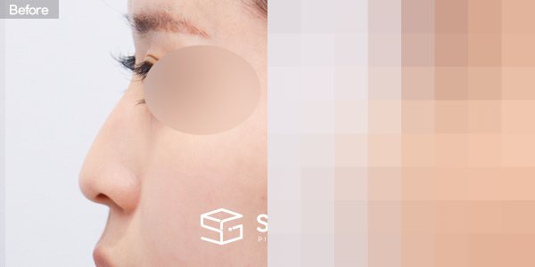 슈가성형외과 첫) 콧대 + 코끝 + 매부리코 + 귀연골 전후사진 - 45도 수술 전후 비교
