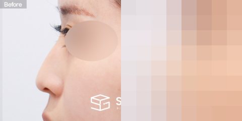 슈가성형외과 첫) 콧대 + 코끝 + 매부리코 + 귀연골 전후사진 - 45도 수술 전후 비교