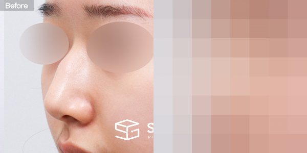 슈가성형외과 첫) 코끝 + 매부리코 + 무보형물 코성형 + 절골 + 귀 뒤 근막 전후사진 - 정면 수술 전후 비교
