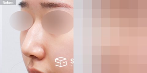 슈가성형외과 첫) 코끝 + 매부리코 + 무보형물 코성형 + 절골 + 귀 뒤 근막 전후사진 - 정면 수술 전후 비교