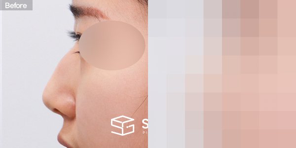 슈가성형외과 첫) 코끝 + 매부리코 + 무보형물 코성형 + 절골 + 귀 뒤 근막 전후사진 - 45도 수술 전후 비교