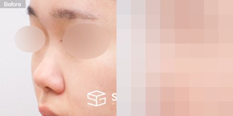 슈가성형외과 첫) 콧대 + 코끝 + 복코 + 코 선반 교정 + 귀연골 전후사진 - 정면 수술 전후 비교