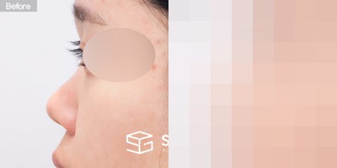 슈가성형외과 첫) 콧대 + 코끝 + 복코 + 코 선반 교정 + 귀연골 전후사진 - 45도 수술 전후 비교