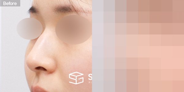 슈가성형외과 첫) 콧대 + 코끝 + 휜코 + 매부리코 + 절골 + 비주 근육 절제 + 귀연골 전후사진 - 정면 수술 전후 비교