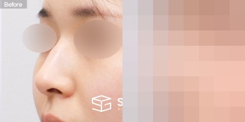 슈가성형외과 첫) 콧대 + 코끝 + 휜코 + 매부리코 + 절골 + 비주 근육 절제 + 귀연골 전후사진 - 정면 수술 전후 비교