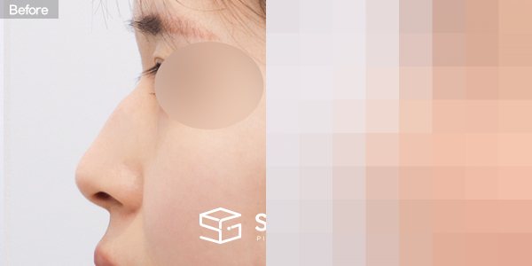 슈가성형외과 첫) 콧대 + 코끝 + 휜코 + 매부리코 + 절골 + 비주 근육 절제 + 귀연골 전후사진 - 45도 수술 전후 비교