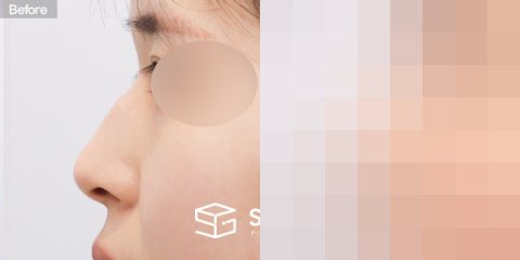 슈가성형외과 첫) 콧대 + 코끝 + 휜코 + 매부리코 + 절골 + 비주 근육 절제 + 귀연골 전후사진 - 45도 수술 전후 비교