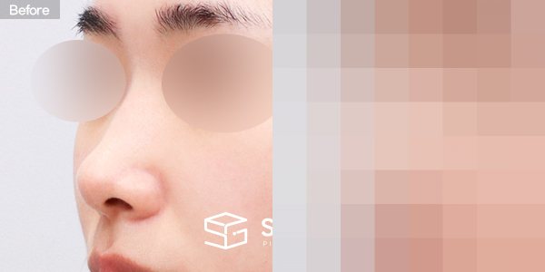 슈가성형외과 첫) 콧대 + 코끝 + 매부리코 + 절골 + 비중격 + 귀연골 전후사진 - 정면 수술 전후 비교