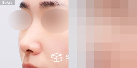 슈가성형외과 첫) 콧대 + 코끝 + 매부리코 + 절골 + 비중격 + 귀연골 전후사진 - 정면 수술 전후 비교