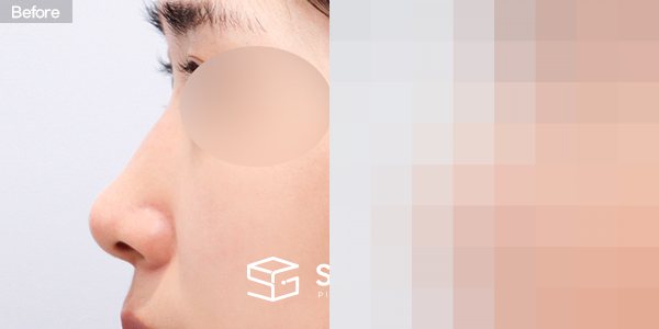 슈가성형외과 첫) 콧대 + 코끝 + 매부리코 + 절골 + 비중격 + 귀연골 전후사진 - 45도 수술 전후 비교