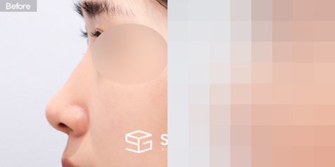 슈가성형외과 첫) 콧대 + 코끝 + 매부리코 + 절골 + 비중격 + 귀연골 전후사진 - 45도 수술 전후 비교