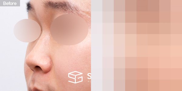 슈가성형외과 첫) 콧대 + 코끝 + 매부리코 + 귀연골 전후사진 - 정면 수술 전후 비교