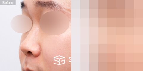슈가성형외과 첫) 콧대 + 코끝 + 매부리코 + 귀연골 전후사진 - 정면 수술 전후 비교