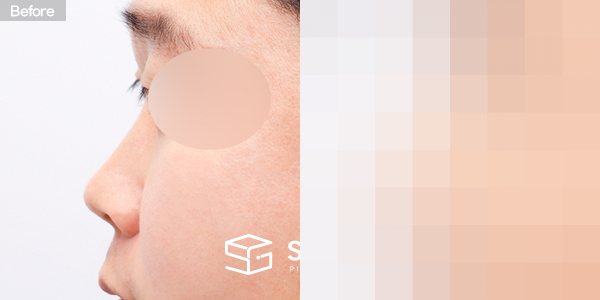 슈가성형외과 첫) 콧대 + 코끝 + 매부리코 + 귀연골 전후사진 - 45도 수술 전후 비교