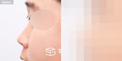 슈가성형외과 첫) 콧대 + 코끝 + 매부리코 + 귀연골 전후사진 - 45도 수술 전후 비교