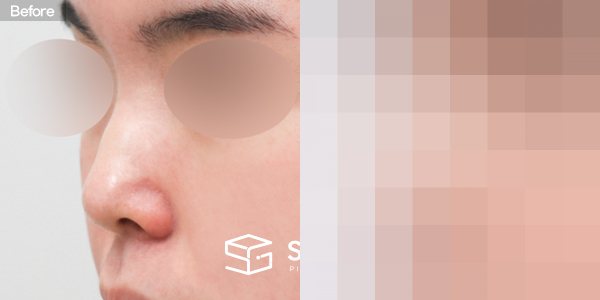 슈가성형외과 첫) 콧대 + 코끝 + 매부리코 + 절골 + 귀연골 전후사진 - 정면 수술 전후 비교