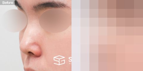 슈가성형외과 첫) 콧대 + 코끝 + 매부리코 + 절골 + 귀연골 전후사진 - 정면 수술 전후 비교