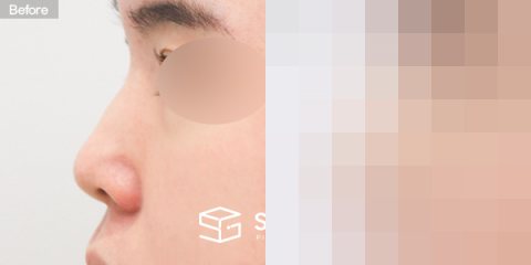 슈가성형외과 첫) 콧대 + 코끝 + 매부리코 + 절골 + 귀연골 전후사진 - 45도 수술 전후 비교