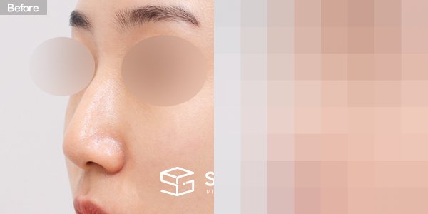 슈가성형외과 첫) 콧대 + 코끝 + 복코 + 매부리코 + 무보형물 코성형 + 절골 + 기증늑 전후사진 - 정면 수술 전후 비교