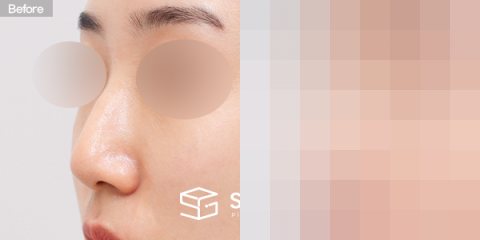 슈가성형외과 첫) 콧대 + 코끝 + 복코 + 매부리코 + 무보형물 코성형 + 절골 + 기증늑 전후사진 - 정면 수술 전후 비교