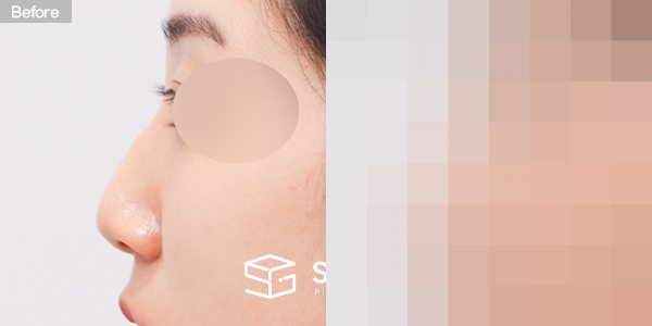 슈가성형외과 첫) 콧대 + 코끝 + 복코 + 매부리코 + 무보형물 코성형 + 절골 + 기증늑 전후사진 - 45도 수술 전후 비교
