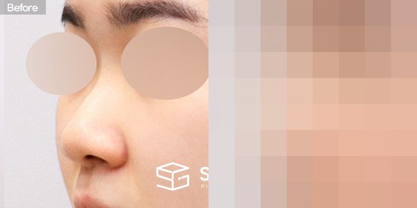 슈가성형외과 첫) 콧대 + 코끝 + 매부리코 + 복코 + 절골 + 콧볼 축소 + 귀연골 전후사진 - 정면 수술 전후 비교