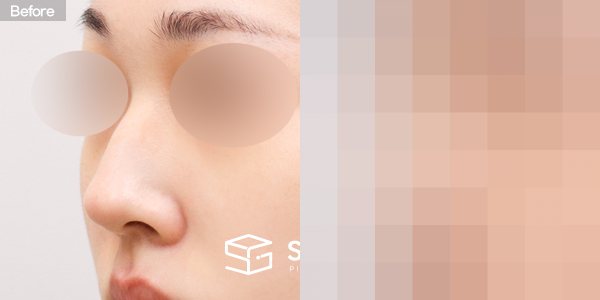 슈가성형외과 첫) 콧대 + 코끝 + 매부리코 전후사진 - 정면 수술 전후 비교