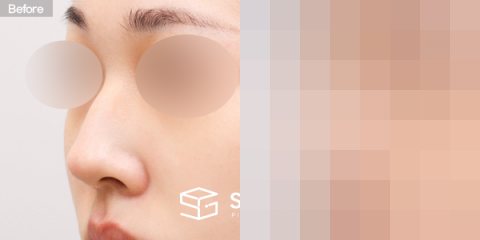 슈가성형외과 첫) 콧대 + 코끝 + 매부리코 전후사진 - 정면 수술 전후 비교